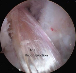 ACL - leczenie operacyjne