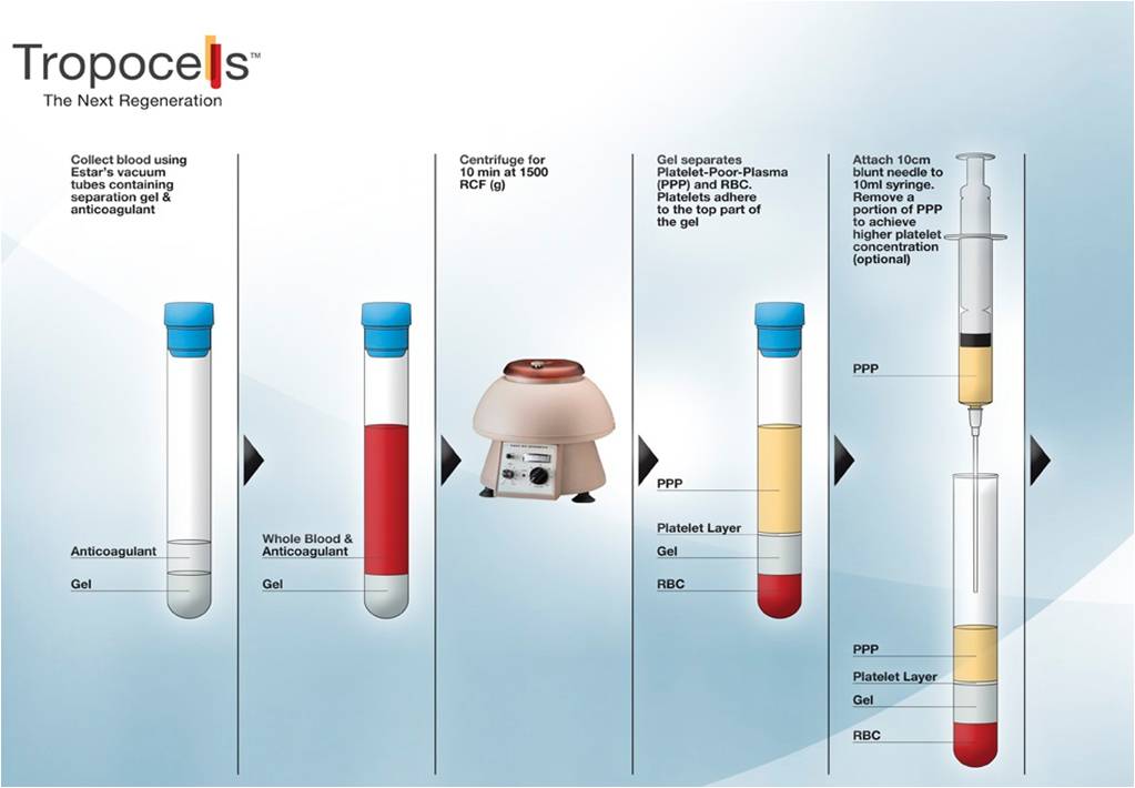 Proces przygotowania PRP1.jpg