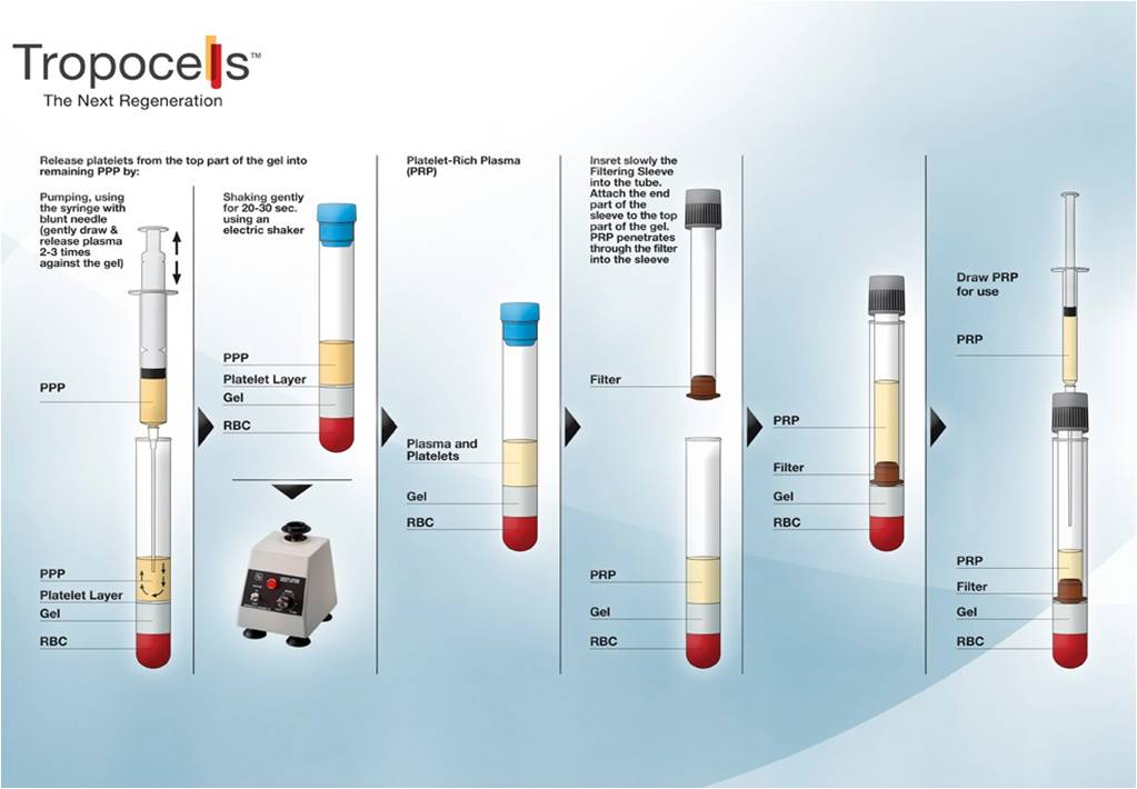 Proces przygotowania PRP2.jpg