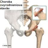 artroza stawu biodrowego artroza tratamentului simptomelor genunchiului