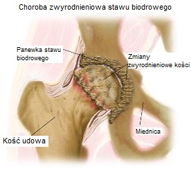 artroza stawu biodrowego