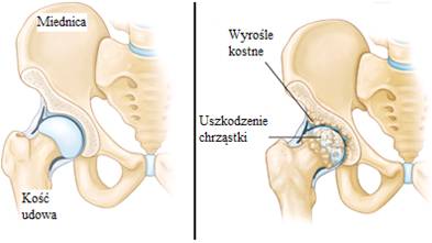 jakie ćwiczenia na zwyrodnienie stawu biodrowego)