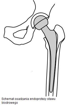 Zabieg wszczepienia endoprotezy stawu biodrowego