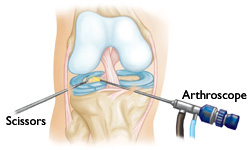 Zabieg artroskopii kolana