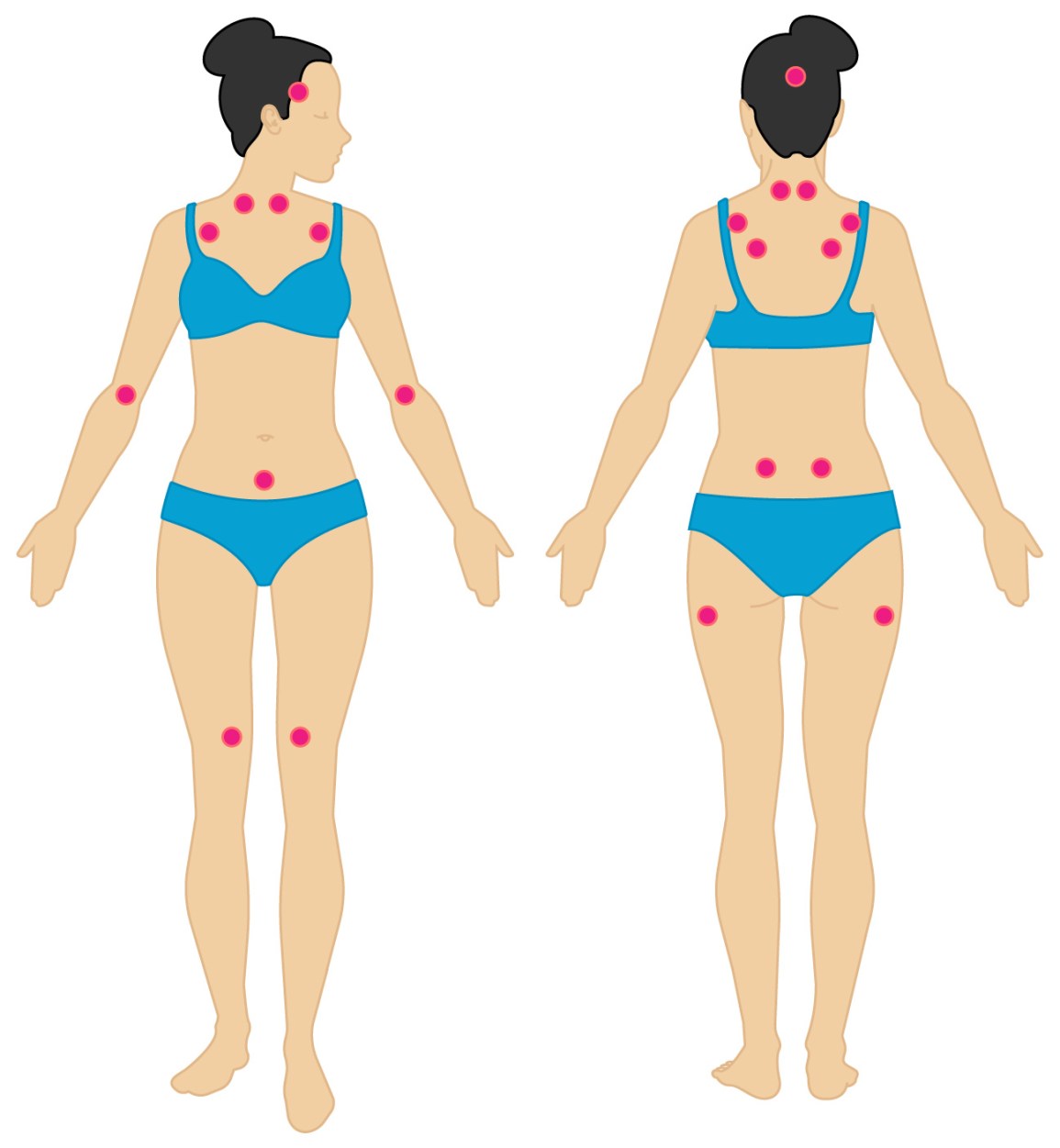 Lokalizacja „punktów tkliwych” u chorych na fibromialgię