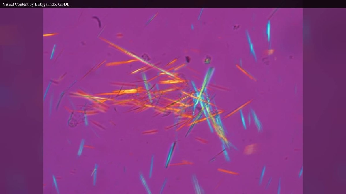 Kryształy moczanu sodu widziane pod mikroskopem