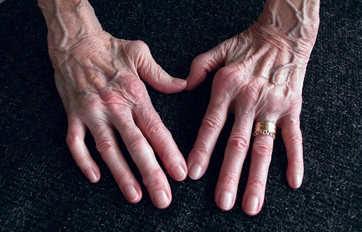 Dłonie osoby chorej na reumatoidalne zapalenie stawów