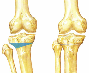  Osteotomia w obrębie stawu kolanowego