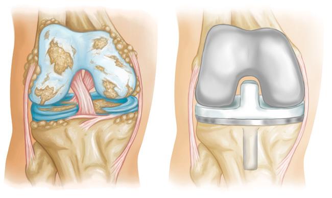Po lewej staw kolanowy z chorobą zwyrodnieniową, po prawej staw po zabiegu endoprotezoplastyki