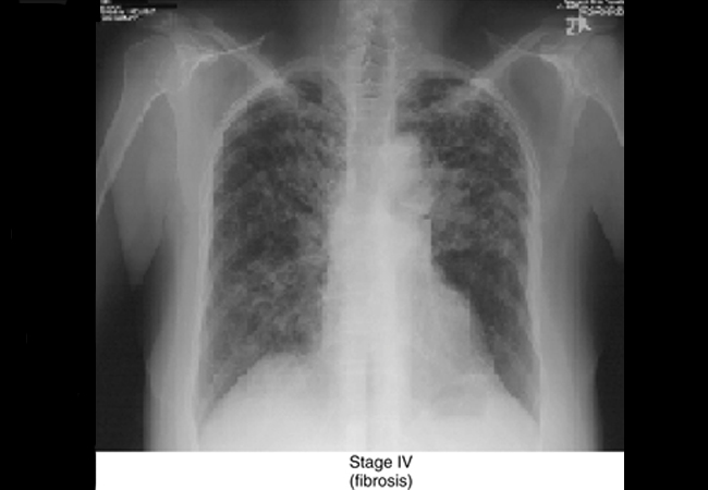 Zdjęcie rentgenowskie przedstawiające włóknienie płuc w przebiegu sarkoidozy