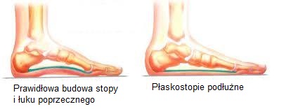 Płaskostopie